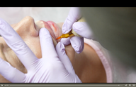 A hand with a gloved finger applies a treatment to a woman's lips.